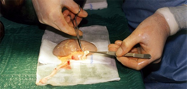 BÄK-Chef und Gröhe werben für Organspende 8 von 10 Deutschen sehen Organspenden positiv, nur ein Bruchteil der Deutschen besitzt aber einen Spenderausweis. Im Bild: Eine Nierentransplantation.