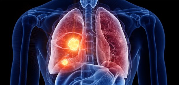 80 Prozent der Patienten mit nicht-kleinzelligem Lungenkarzinom entwickeln unter Radiochemotherapie Rezidive. Eine Zusatztherapie mit Checkpoint-Inhibitor bessert die Überlebenschancen deutlich.