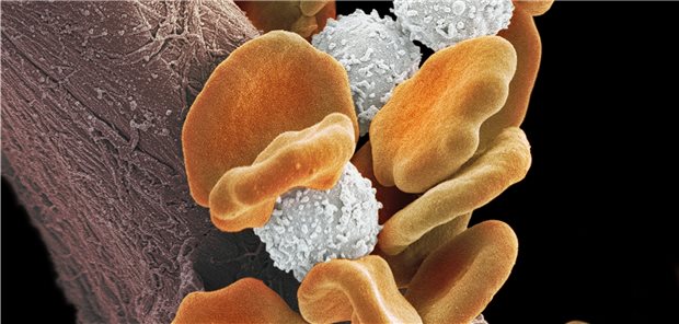Bösartig veränderte B-Zellen (weiß) und Erythrozyten (orange) im Elektronenmikroskop.