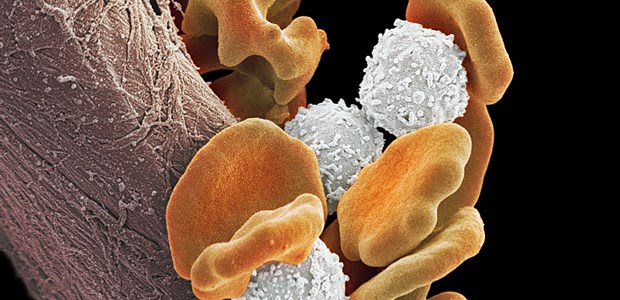 ALL: Entartete B-Zellen (weiß) und rote Blutkörperchen (orange) im Elektronenmikroskop.