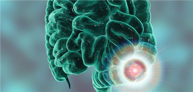 Illustration einer Darmkrebs-Läsion, die rot im Dickdarm aufleuchtet.