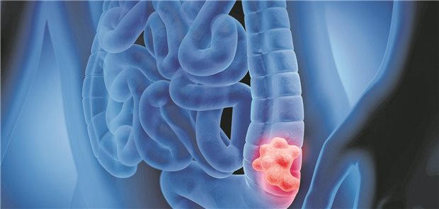 Modell eines Körpers in dem der Darm zu sehen ist. Im Dickdarm befindet sich ein Tumor. 