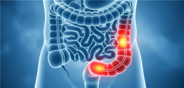 Modell eines Körpers in dem der Darm zu sehen ist. Im Dickdarm befindet sich ein Tumor. 