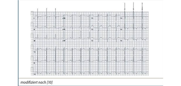 Abb. 1: EKG eines Patienten mit schwerer Mitralinsuffizienz mit linksventrikulärer Hypertrophie und linksatrialer Vergrößerung