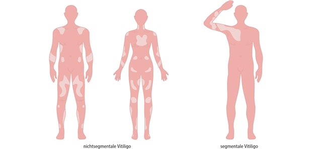 Abb. 1: Formen von Vitiligo