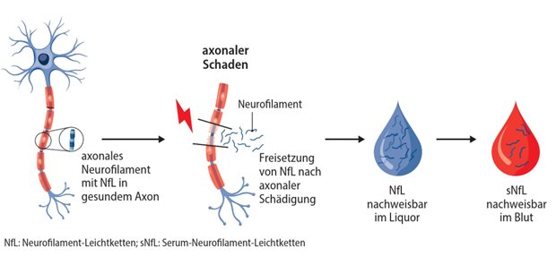 Abb. 1: Freisetzung von Neurofilamenten aus geschädigtem Axon 