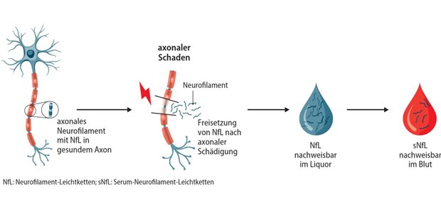 Abb. 1: Freisetzung von Neurofilamenten aus geschädigtem Axon