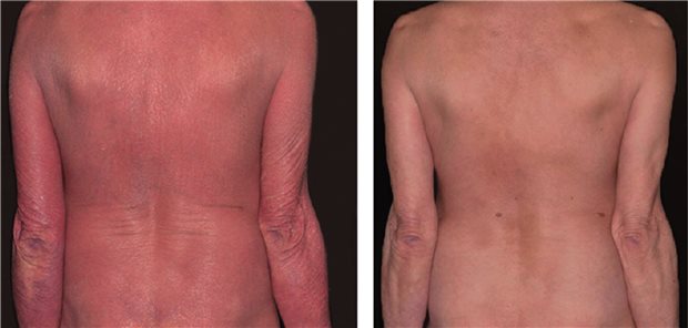 Abb. 1: Hautzustand des Patienten vor Therapiebeginn (links) und nach vier Jahren (rechts) unter Ixekizumab 