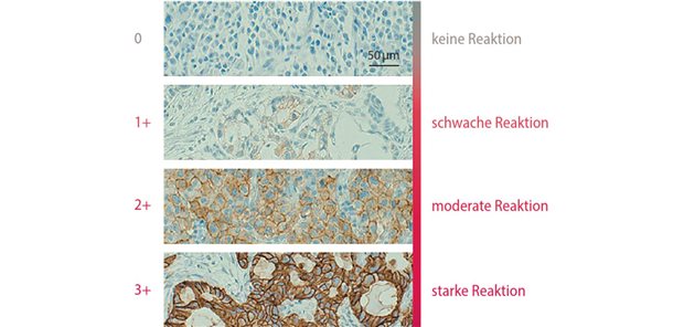 Abb. 1: Immunhistochemie-Scoring / Färbeintensität für Claudin 18.2