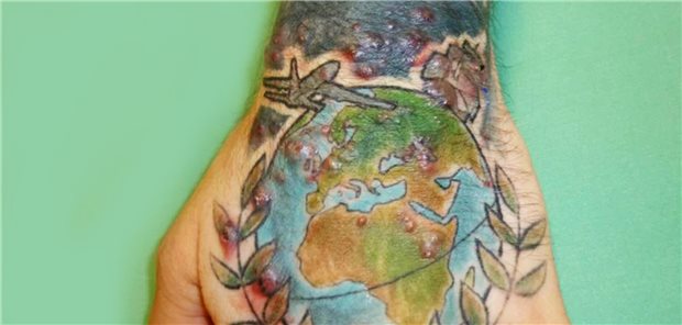 Klinischer Befund des linken Handrückens bei Erstvorstellung: Im Bereich des tätowierten Areals zeigen sich multiple bis zu 3mm durchmessende erythematöse Papeln und Pusteln.