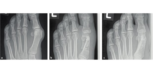 Abb. 1: Korrektur eines Hallux valgus: Die Röntgenbilder zeigen einen mit MgYREZr-Schrauben versorgten Hallux valgus am linken Fuß vor der Operation(a), mehrere Wochen(b) und ein Jahr nach der Operation(c) 