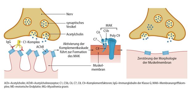 Abb. 1: Myastenia gravis: Komplementbindung und -aktivierung an der neuromuskulären Endplatte (nach [6])
