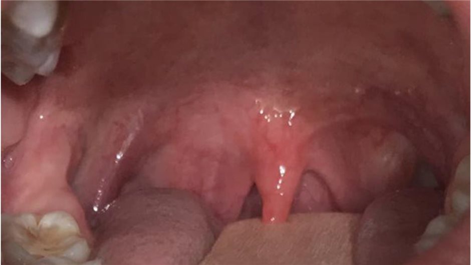 Abb. 1: Nichtexsudative Pharyngitis 