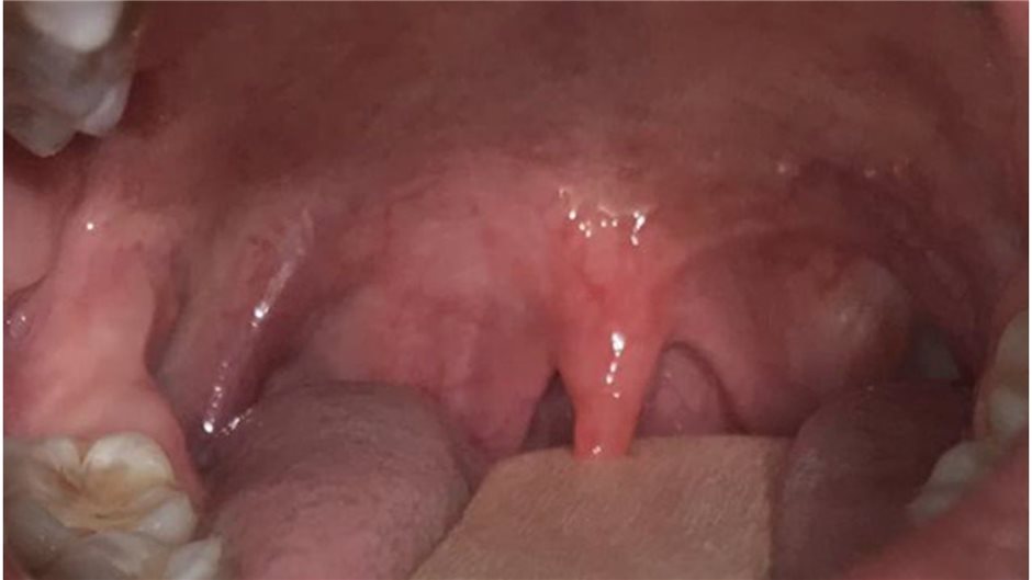 Abb. 1: Nichtexsudative Pharyngitis. 