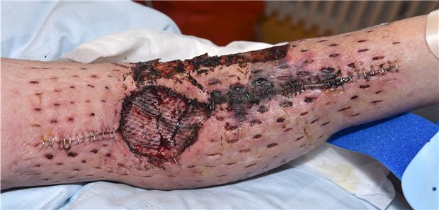 Abb. 1: Spalthauttransplantation bei Unterarmfraktur und Kompartmentspaltung nach Trauma