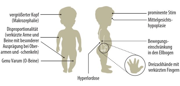 Abb. 1: Typische Körperumrisse bei Achondroplasie