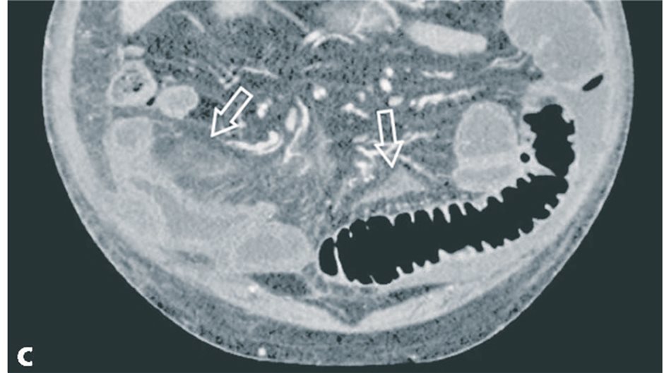 Abb. 1c: Die coronale 3D-Rekonstruktion der CT zeigt deutliche Zeichen einer Per...