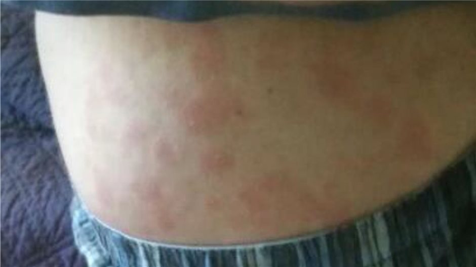 Abb. 2a: Makulopapulöses, flüchtiges Exanthem, nichtjuckend am Rumpf.