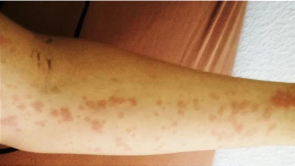 Abb. 2b: Makulopapulöses, flüchtiges Exanthem, nichtjuckend an Extremität.