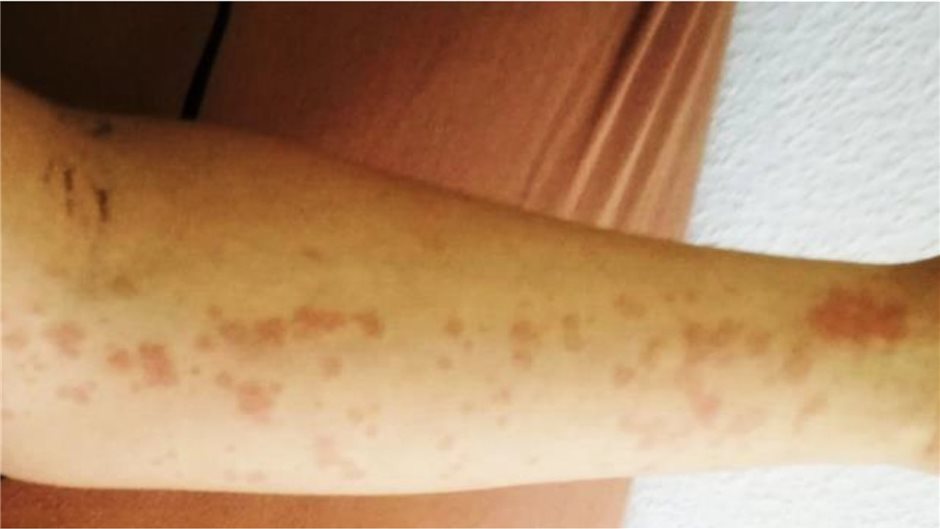 Abb. 2b: Makulopapulöses, flüchtiges Exanthem, nichtjuckend an Extremitäten 