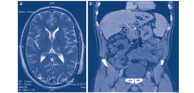 Abb. 3: Thrombophilie bei PNH: Wie hier dargestellt, können Thrombosen an unterschiedlichen Lokalisationen sowohl arteriell als auch venös auftreten: (A) lakunärer Thalamusinfarkt links; (B) Pfortaderthrombose. Beide Ereignisse waren bei dem dargestellten Patienten vor der Erstdiagnose PNH aufgetreten (mit freundlicher Genehmigung von A. Röth, Essen)