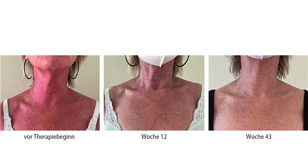 Abb.1: Rückgang der Hautläsionen an Hals und Dekolletee unter der Baricitinib-Therapie