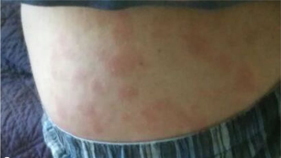 Abbi. 2a: Makulopapulöses, flüchtiges Exanthem, nichtjuckend am Rumpf