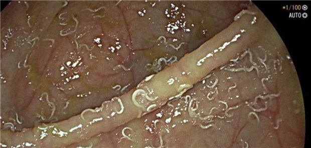 Links: Metastasensuspekter Leberrundherd in Segment II. Rechts: Thrombosierter Seitenast (Pfeil) der V. mesenterica inferior links parakolisch mit entzündlicher Umgebungsreaktion
