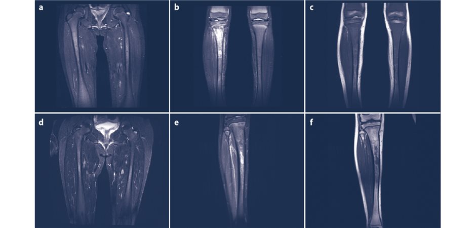 Skelettbeteiligung bei Morbus Gaucher