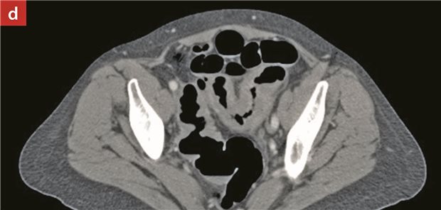 Abbildung d: CT-Abdomen Oktober 2019: langstreckige Stenose und Wandverdickung im Sigma.