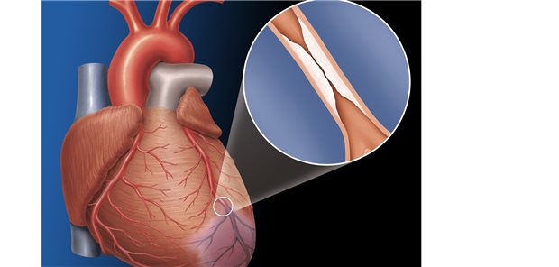 Abbildung einer Koronararterienstenose mit resultierendem Infarktbereich und Lupendarstellung der Stenose.