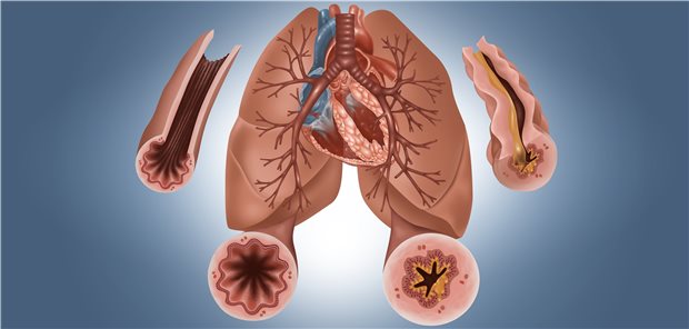 Abbildung einer Lunge mit gesunden Atemwegen (links)
und entzündlich veränderten, verengten Atemwegen mit Schleimbildung (rechts).