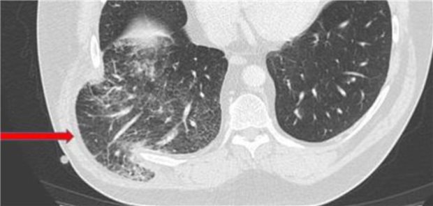 Abbildung oben: In der Computertomografie des Thorax zeigte sich als Erklärung für den tastbaren Tumor mit innerlicher Krepitation eine Ruptur der Interkostalmuskulatur im 8. Interkostalraum rechts mit Herniation von Lungenanteilen. Die Pfeile zeigen die hernierten Anteile der Lunge nach Ruptur der Interkostalmuskulatur.