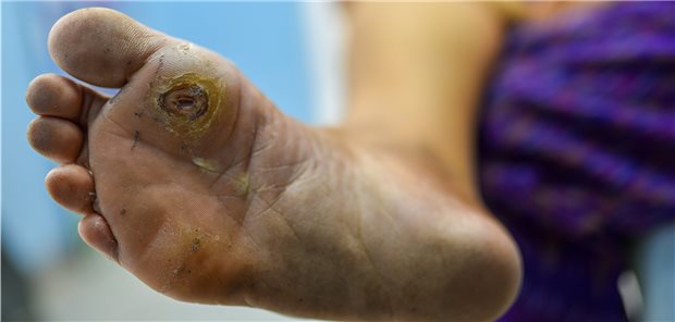 Abheilendes Fußulkus: Ob sich durch die Versorgung Betroffener via Videokonsultationen stationäre Aufnahmen und Amputationen verhindern lassen, wird bezweifelt.