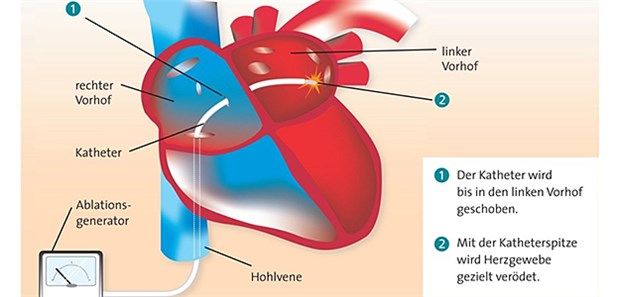 Katheterablation hilft besser als Medikamente Ablauf einer Katheterablation bei Vorhofflimmern.