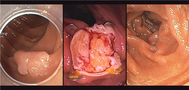 Abtragung eines Zwölffingerdarm-Adenoms: Der Polyp (li.), die Resektionsstelle nach der Abtragung (Mitte) und die gleiche Stelle zwei Jahre später bei der Kontrolle (re.). Mit Hilfe der endoskopischen Vollwandresektion ist dies jetzt ohne Op möglich.