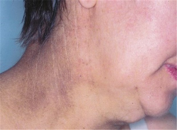 Ein äußeres Zeichen innerer Erkrankungen Acanthosis nigricans. Der Patient hat grau-braune, verdickte Hautrelieffalten am Nacken. © (3) Professor emeritus Walter Krause, Universität Marburg