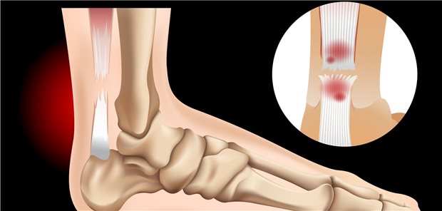 Achillessehnenriss: Minimalinvasive oder offene Op. oder doch besser konservativ versorgen?