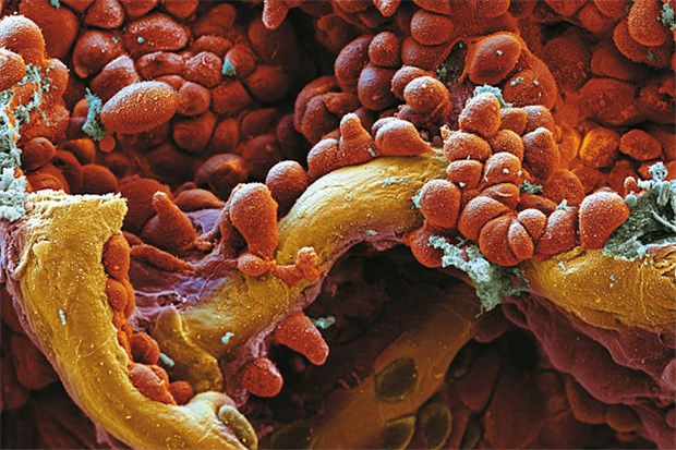 Faszinierender Blick in den Mikrokosmos der Lunge Adenokarzinom der Lunge bei 1500-facher Vergrößerung. Die prallen, mit kurzen Zilien besetzten Zellen sind Adenokarzinomzellen, die in die Alveolen einwachsen.