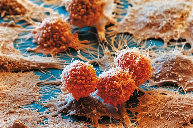 Faszinierender Blick in den Mikrokosmos der Lunge Adenokarzinomzellen, 7000-fach vergrößert. Die Karzinome entstehen aus den peripheren Zellen der Bronchialdrüsen. Zu sehen sind Zellen mit dem charakteristischen, drüsenartigen Wachstumsmuster.