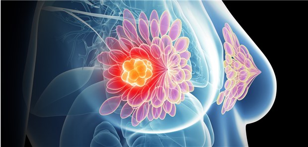 Adipöse Brustkrebspatientinnen haben nach neoadjuvanter Chemotherapie und Lymphknotendissektion ein höheres Lymphödemrisiko. 