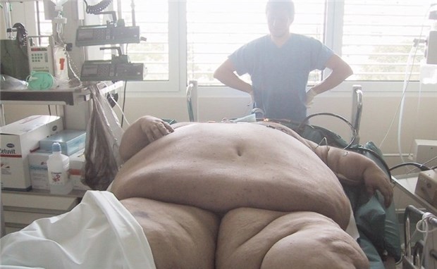 Extrem dicken Menschen hilft oft nur Chirurgie Adipöser Patient mit 357 kg. Die Operation erfordert eine geeignete Infrastruktur.