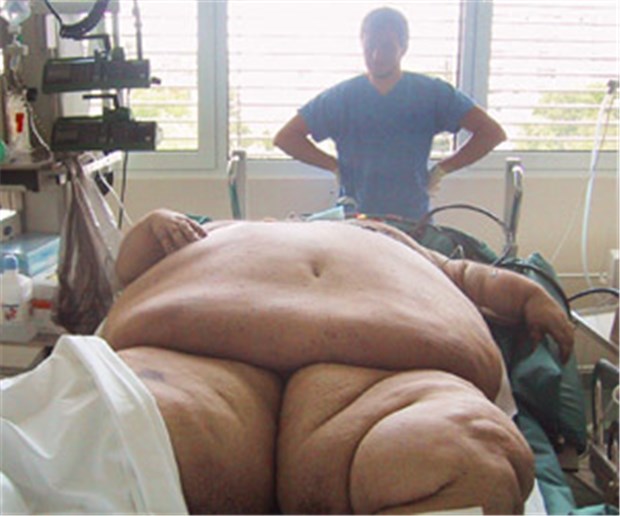 Dickes Problem für Kliniken: Der Aufwand bei Fettleibigen ist enorm Adipöser Patient mit 357 kg Gewicht. Bei solchen Fettleibigen werden Diagnostik und Therapie oft zum Problem.