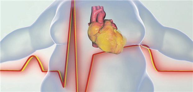 Grafik eines übergewichtigen Menschen und einem EKG
