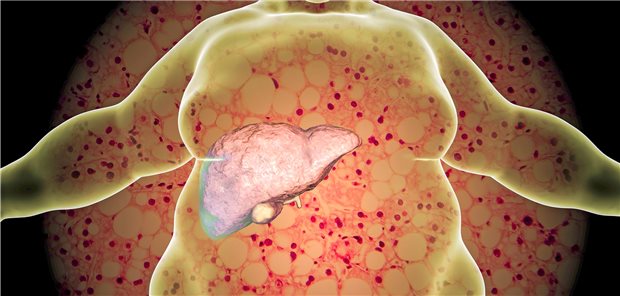 Adipositas und Fettleber im Modell (im Hintergrund ein histologischer Schnitt des kranken Organs). Drei von vier Typ-2-Diabetiker sind davon betroffen.