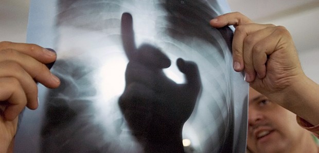 Die TB-Infektionen sinken, die Risiken steigen Ärzte diskutieren eine Röntgenaufnahme: Infektionen mit Tuberkulose bleiben dabei zu häufig unentdeckt.