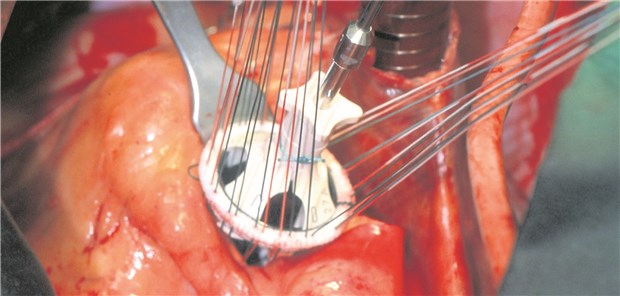 Ärzte raten eine Klappenersatz-Op auf drei bis vier Monate nach Schlaganfall aufzuschieben.