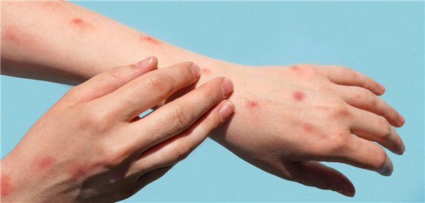 Affenpocken: In vielen Ländern fehlt es an einer verlässlichen Diagnostik, kritisieren Forschende.