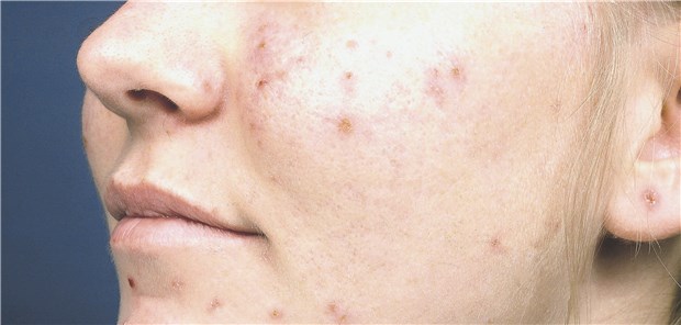 Akne: Die Leitlinien empfehlen medikamentöse Behandlung.