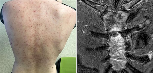 Akne-Effloreszenzen am Rücken (links) und MRT des Sternums, zu sehen ist ein Knochenmarködem (rechts).